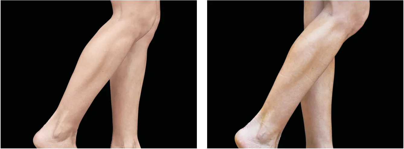 Emsculpt jalat example 1