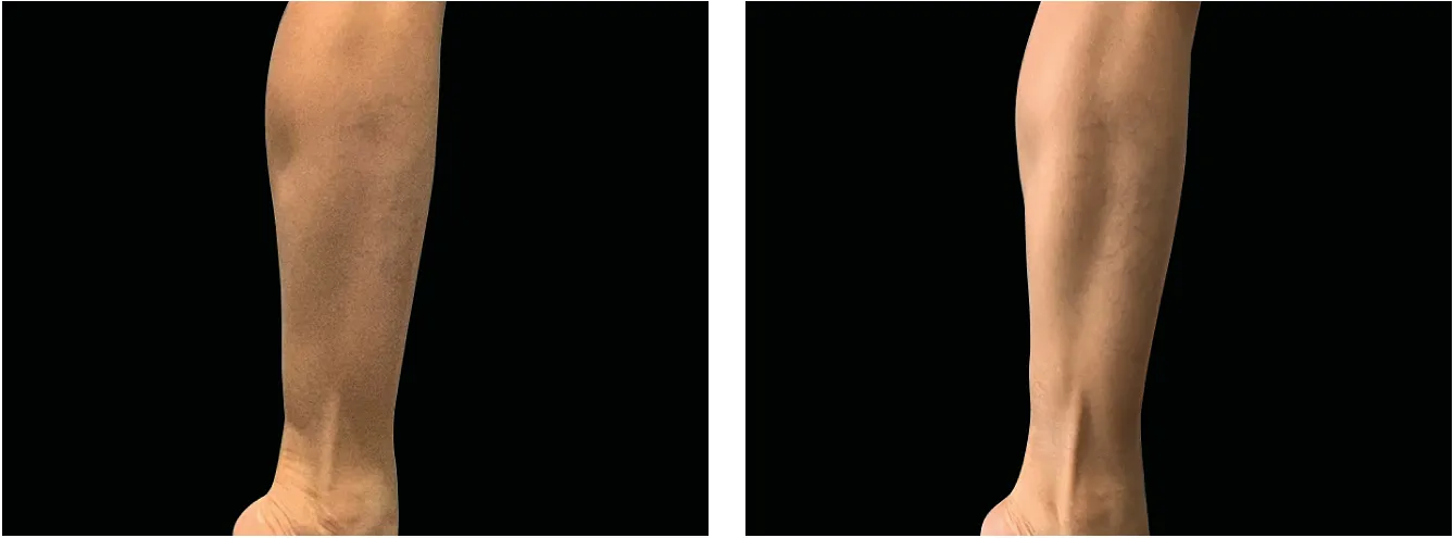 Emsculpt jalat example 2