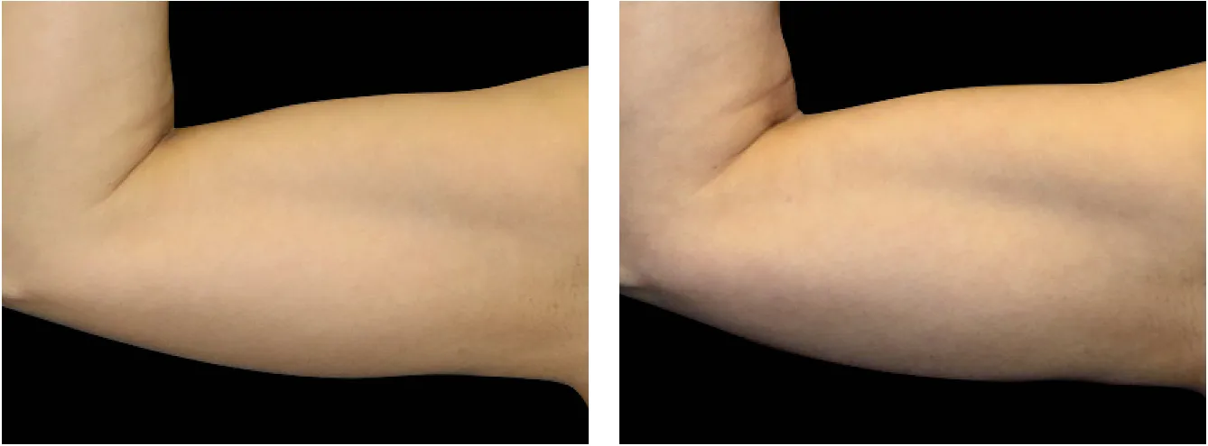 Emsculpt kadet example 1