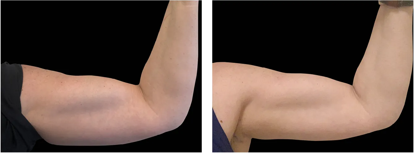 Emsculpt kadet example 2