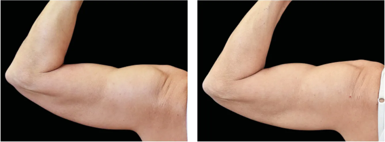 Emsculpt kadet example 3