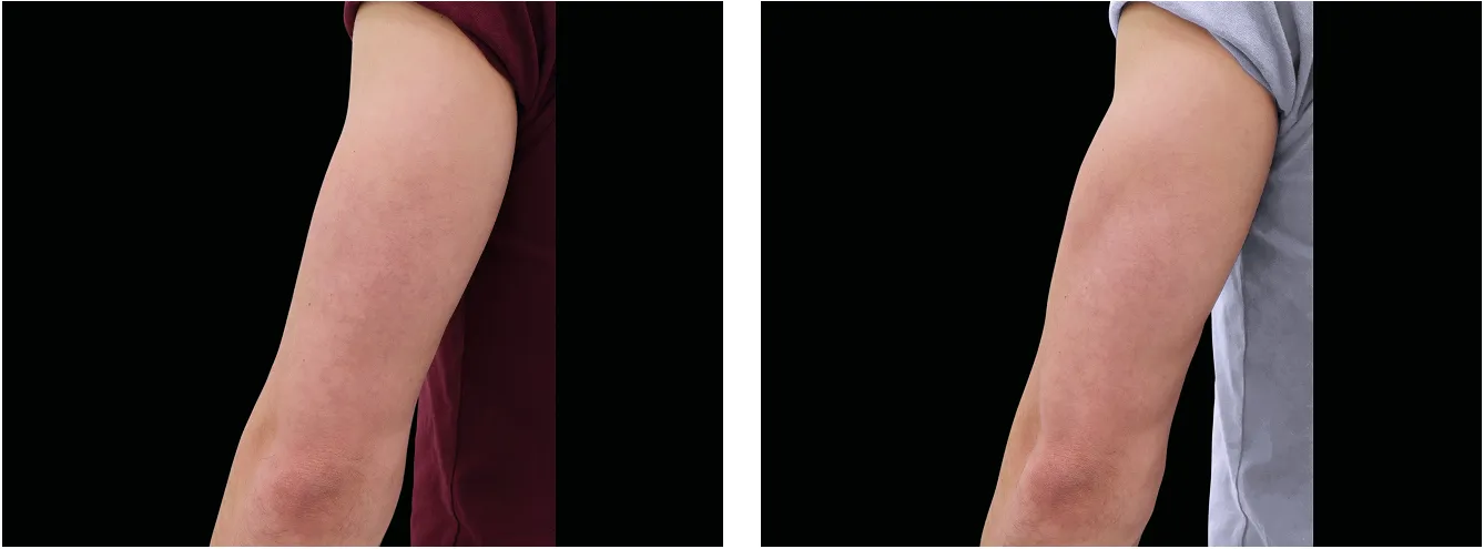 Emsculpt kadet example 4