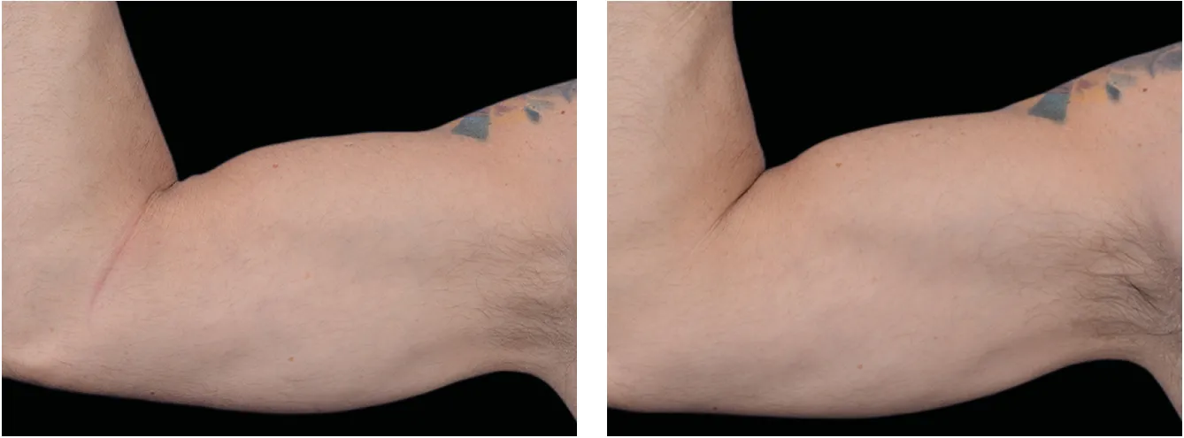 Emsculpt kadet example 5