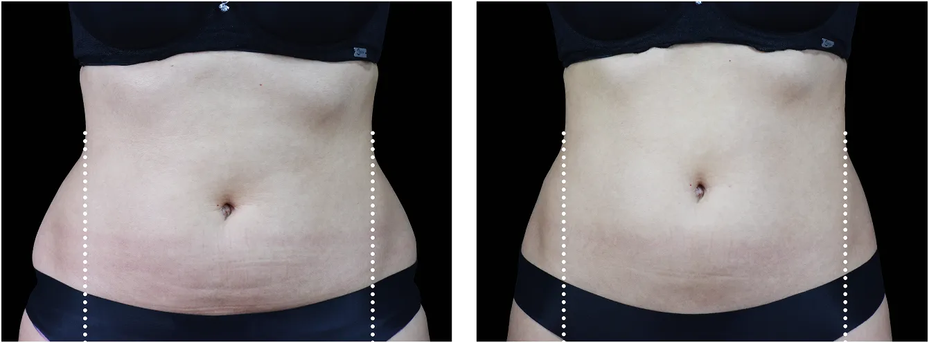 Emsculpt kyjet example 1