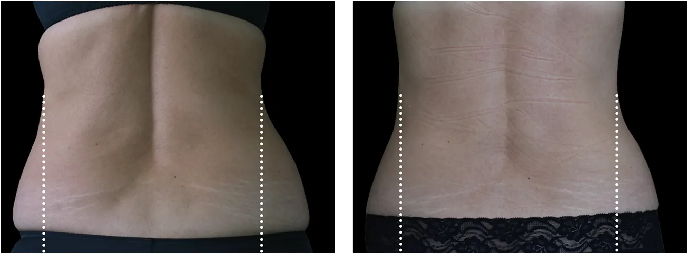 Emsculpt kyjet example 2