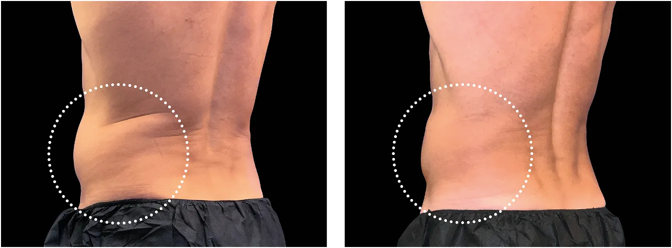 Emsculpt kyjet example 3