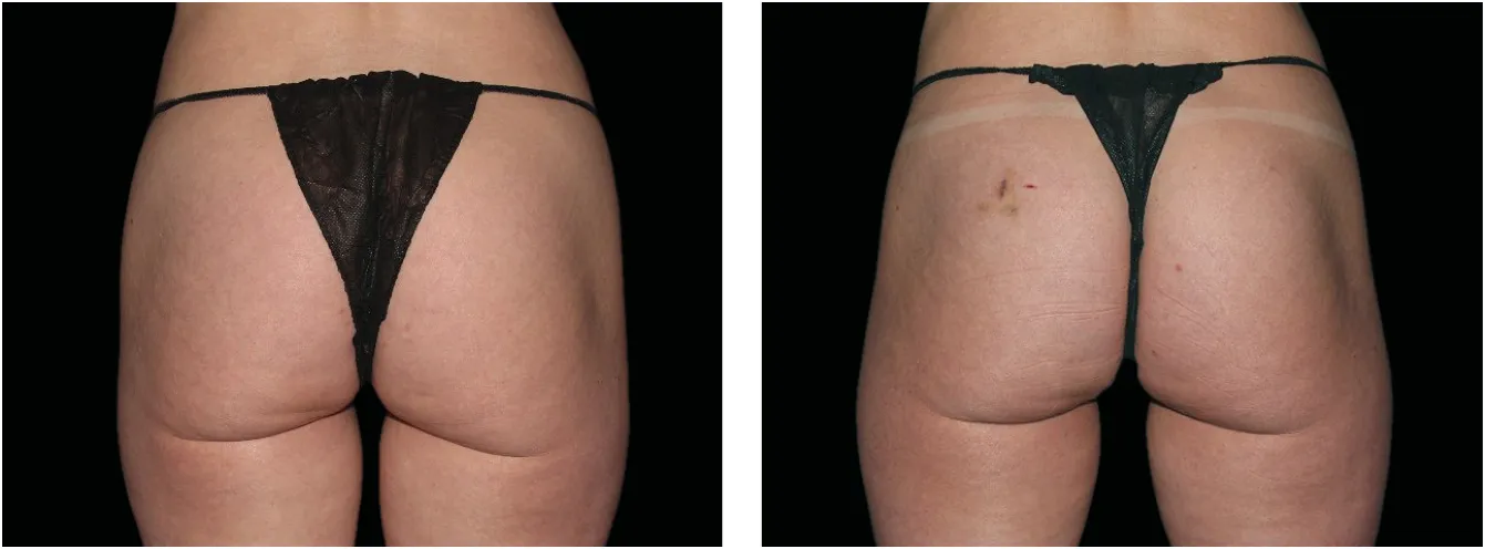 Emsculpt pakarat example 1