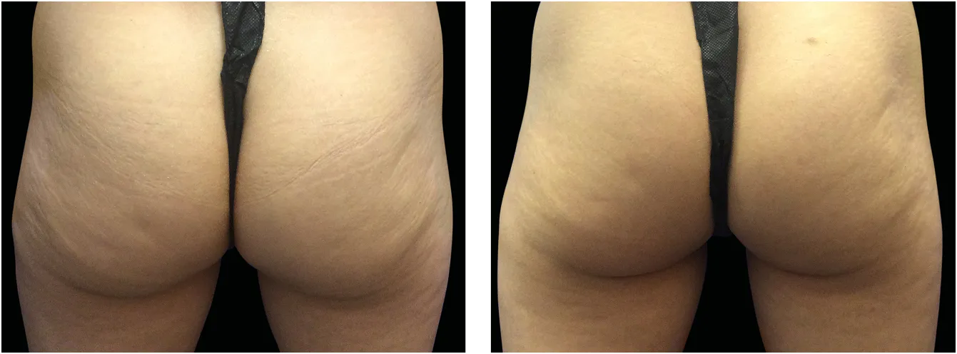 Emsculpt pakarat example 2