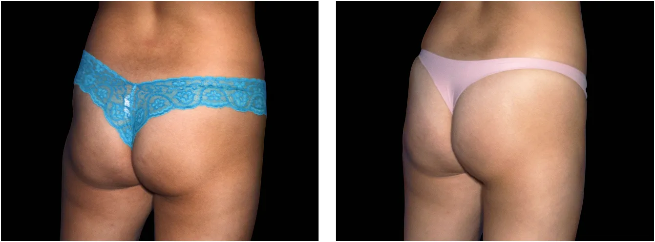 Emsculpt pakarat example 3