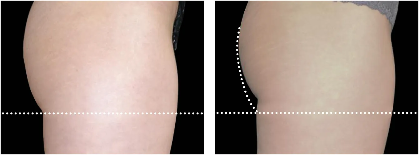 Emsculpt pakarat example 4