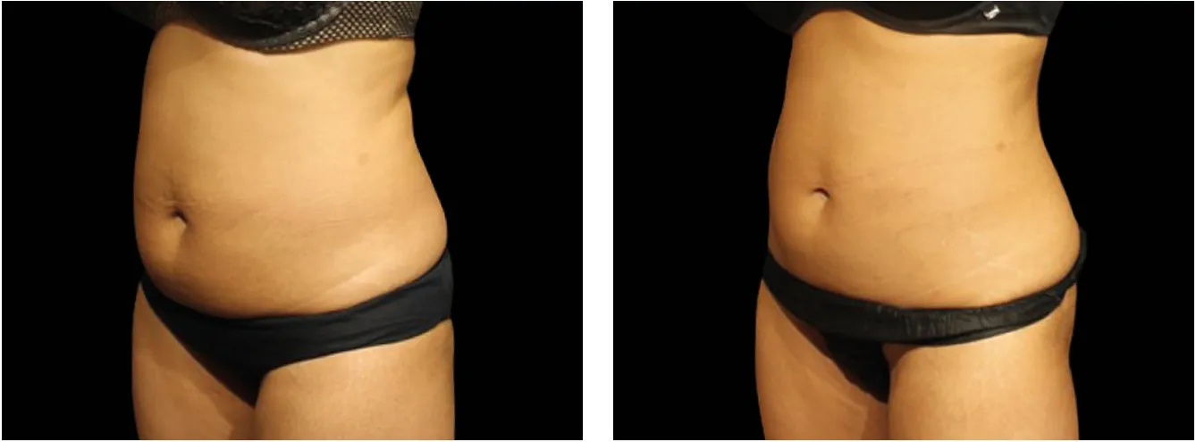 Emsculpt vatsa example 1