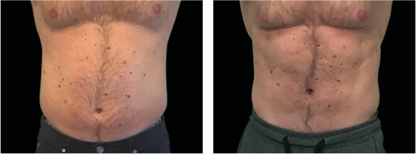 Emsculpt vatsa example 2