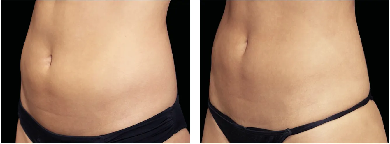 Emsculpt vatsa example 3