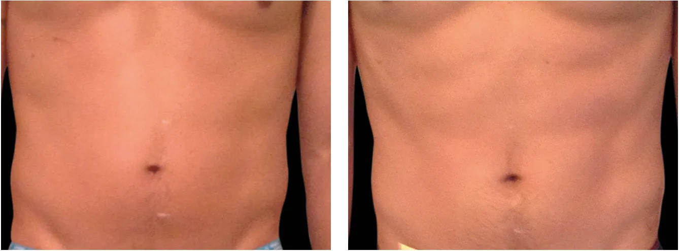 Emsculpt vatsa example 4