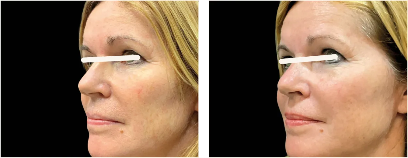 exion face kasvot example 2