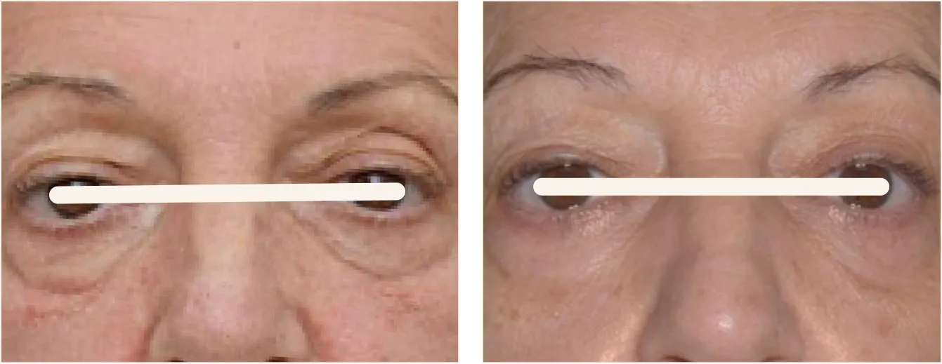 exion face silmät example 1
