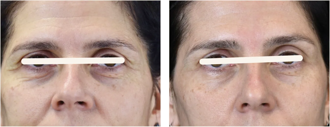exion face silmät example 2