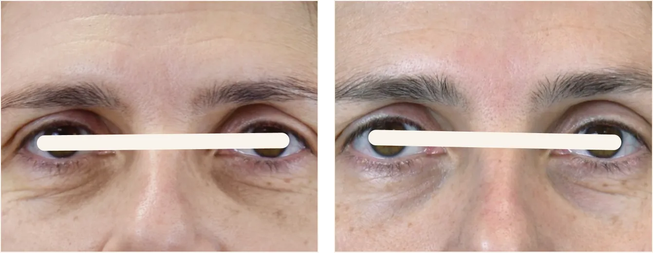 exion face silmät example 3