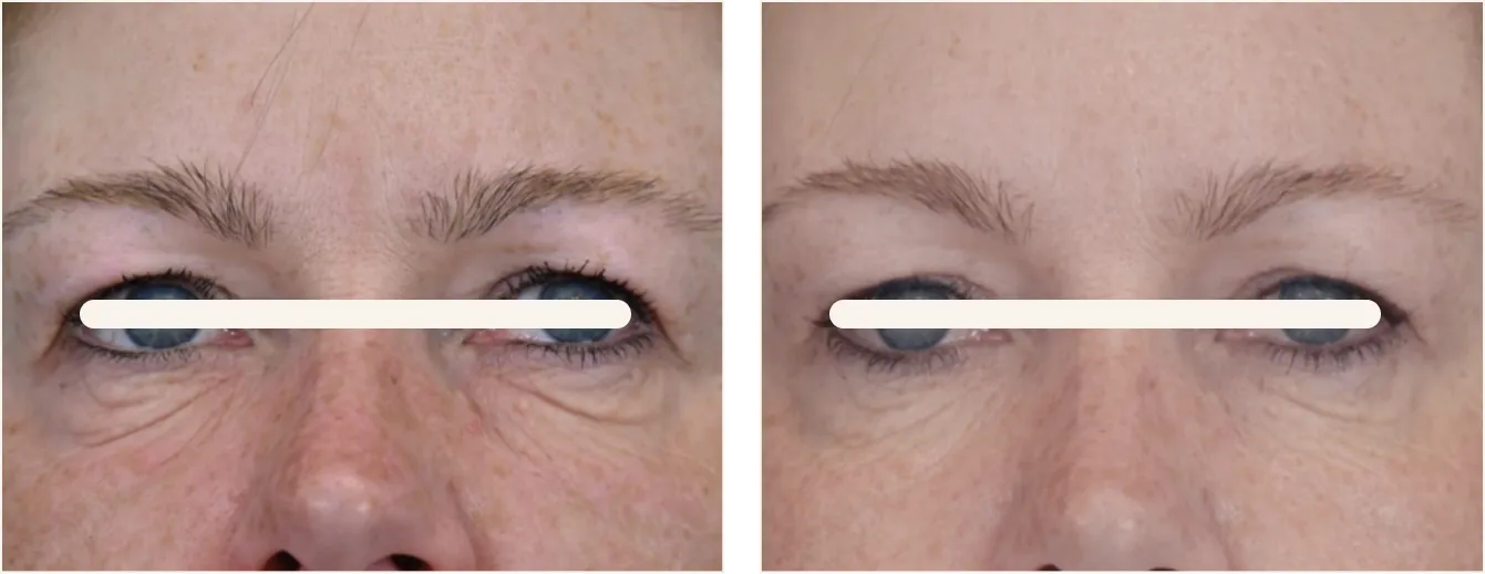 exion face silmät example 5