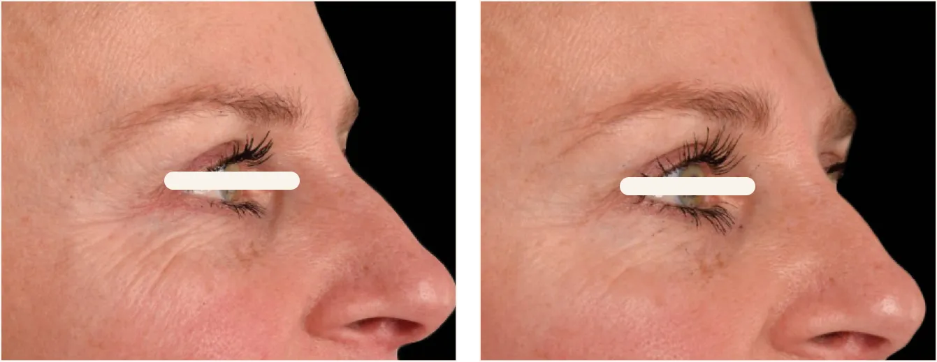 exion face silmät example 6