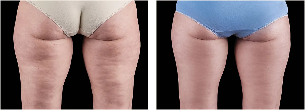 emtone cellulite example 1