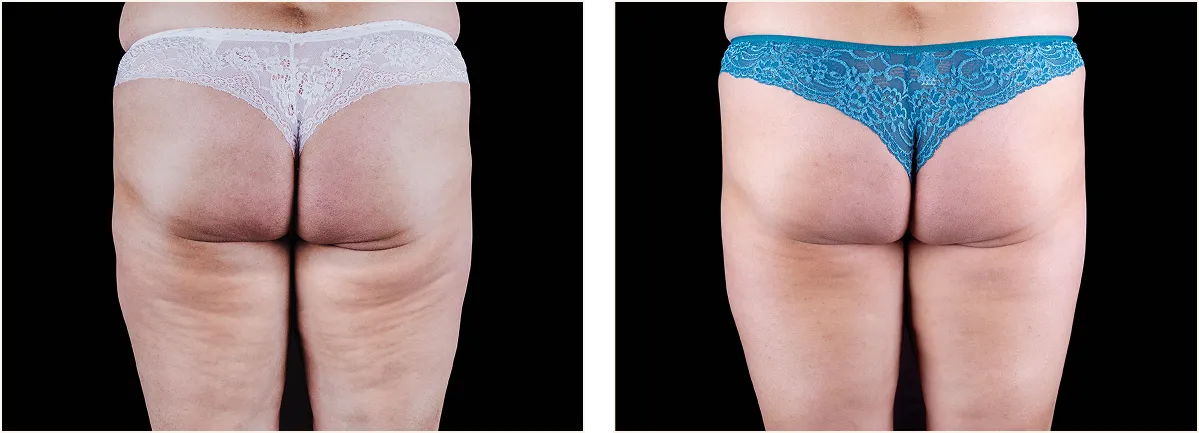 emtone cellulite example 2