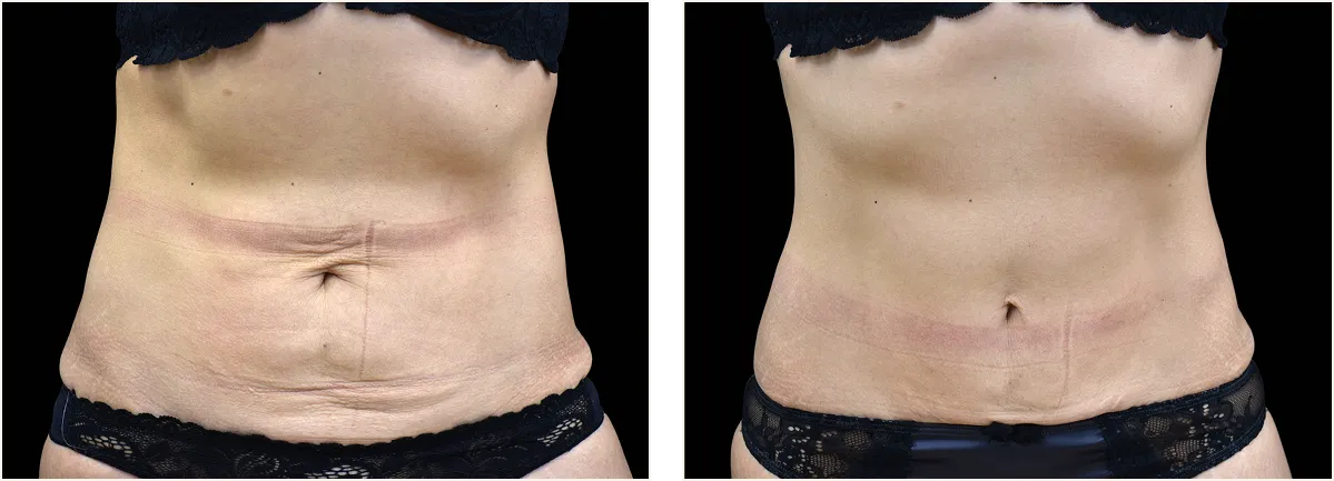 emtone cellulite example 3