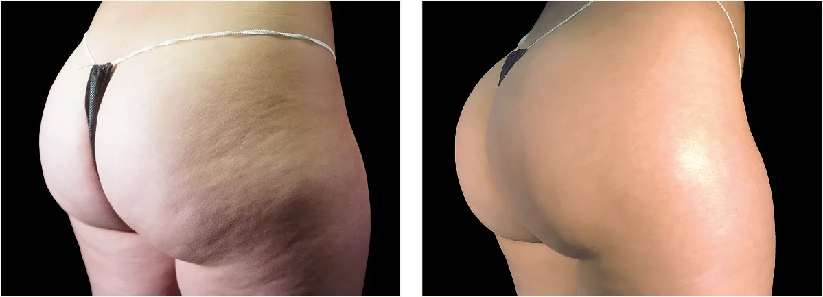 emtone cellulite example 4