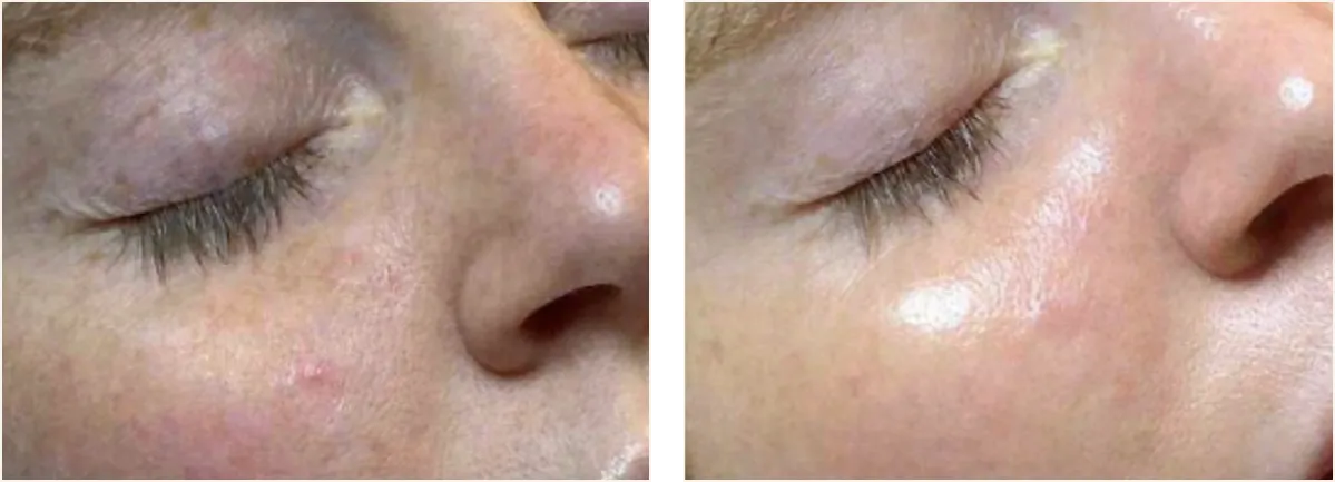 hydrafacial example 1