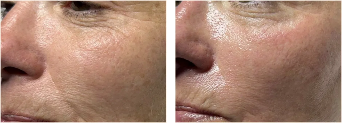 hydrafacial example 2