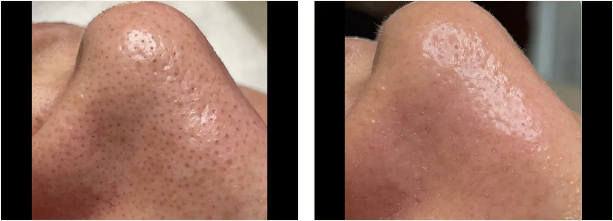 hydrafacial example 3