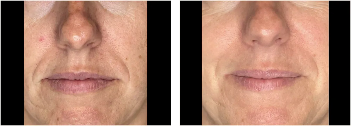 hydrafacial example 4
