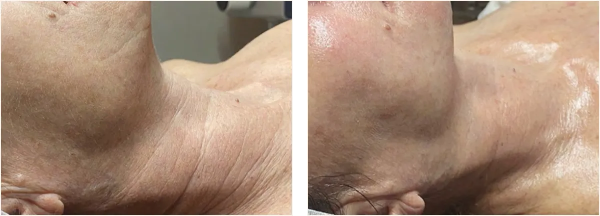 hydrafacial example 5