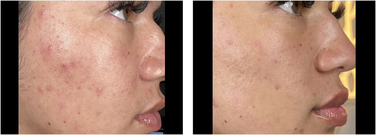 hydrafacial example 6