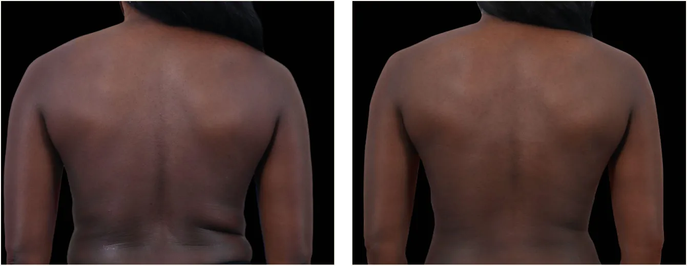 exion body vartalo example 4