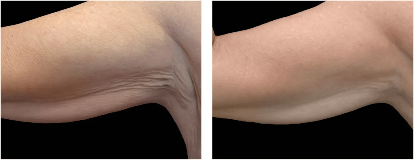 exion body vartalo example 5