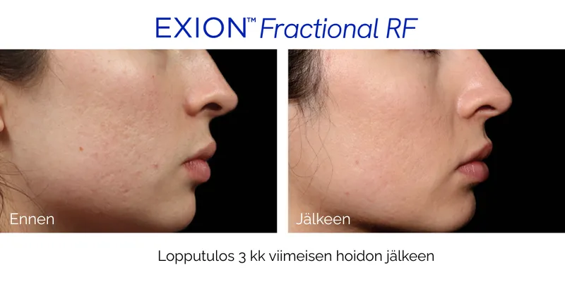 Ennen ja jälkeen EXION Fractional RF -hoidon – aknearpien häivytys ja ihon rakenteen tasoittuminen 3 kuukauden kuluttua