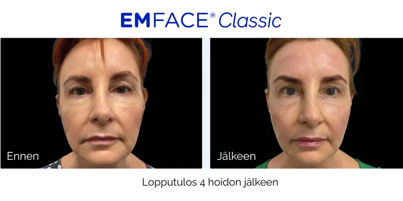Ennen ja jälkeen EMFACE-hoidon – kasvojen kiinteytys ja kohotus 4 hoitokerran jälkeen, iho näyttää napakammalta ja tasaisemmalta