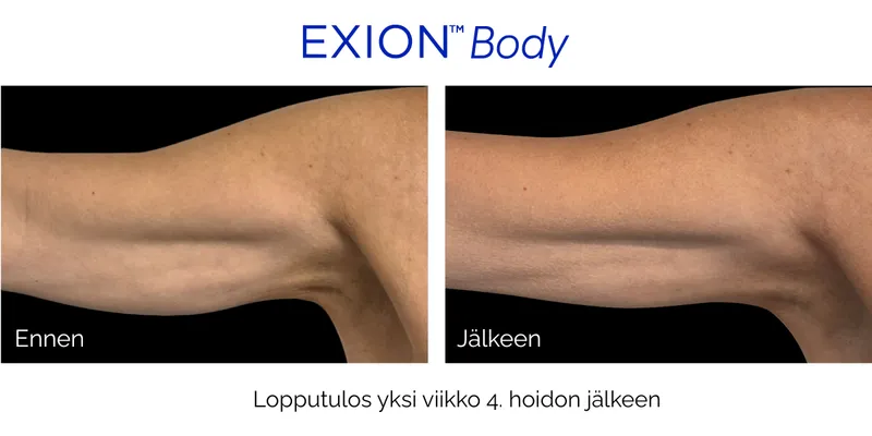 Allit ennen ja jälkeen EXION Body -hoidon, lopputulos 1 viikko 4. hoidon jälkeen