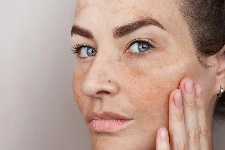 Pigmentation image 1