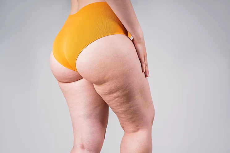 What is cellulite image 1