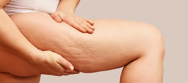 What is cellulite image 2