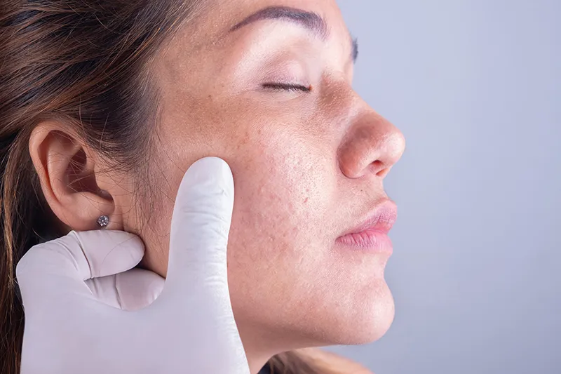 Acne scars image 3