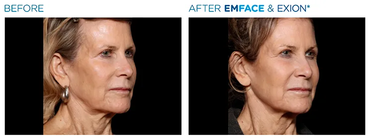 Facial skin sagging image 4