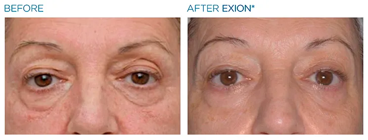 Sagging eyelids - what can help them image 4