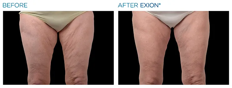What is cellulite image 4