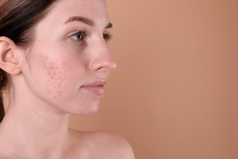 Acne scars image 1