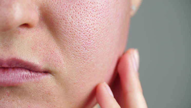 Enlarged pores image 1