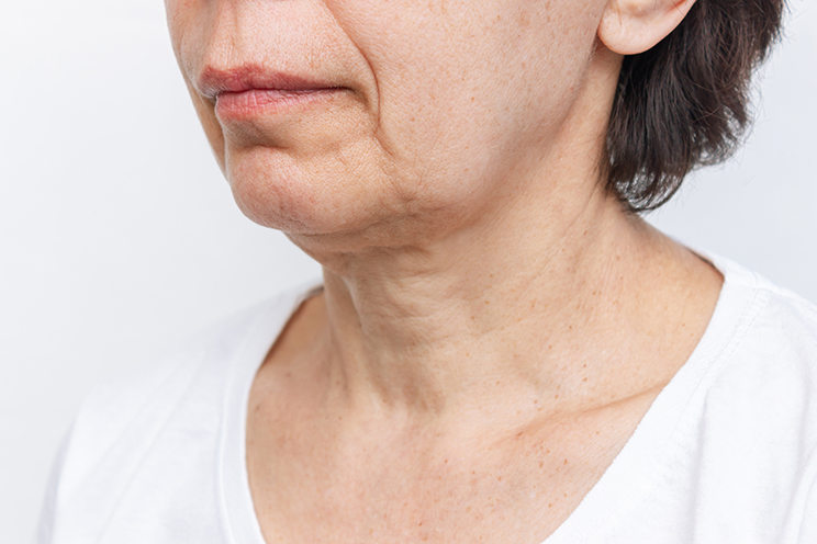 Facial skin sagging image 1