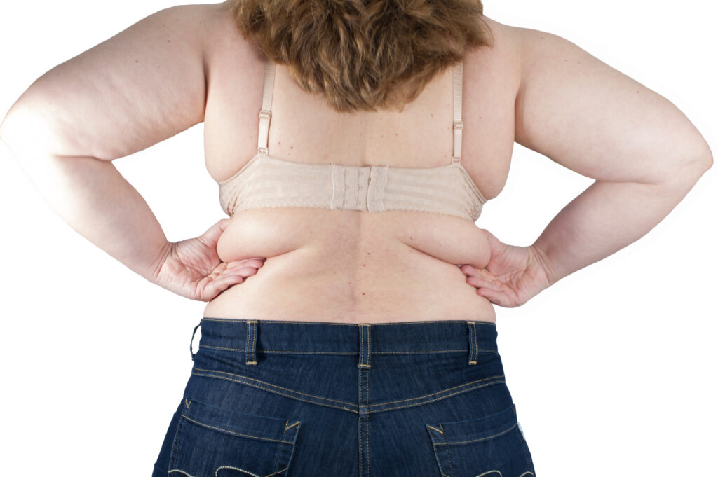 Fat folds image 1